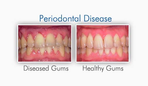 پیوند لثه چیست؟ جراحی پیوند لثه